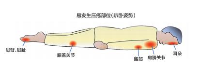 压疮最新护理，提升患者舒适度与治疗效果的关键