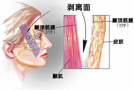 最新拉皮手术方式与技术的革新